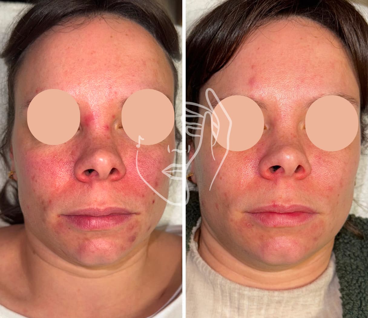 Lympho Sculpt® ANA GIA