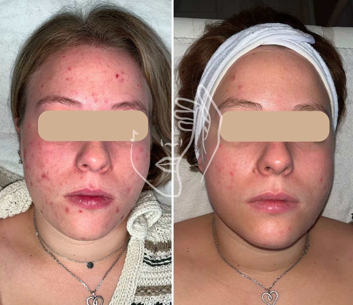 Lympho Sculpt® ANA GIA