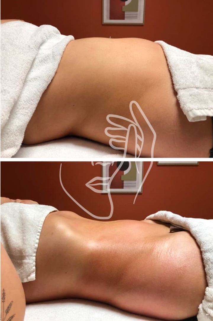 Lympho Sculpt® ANA GIA