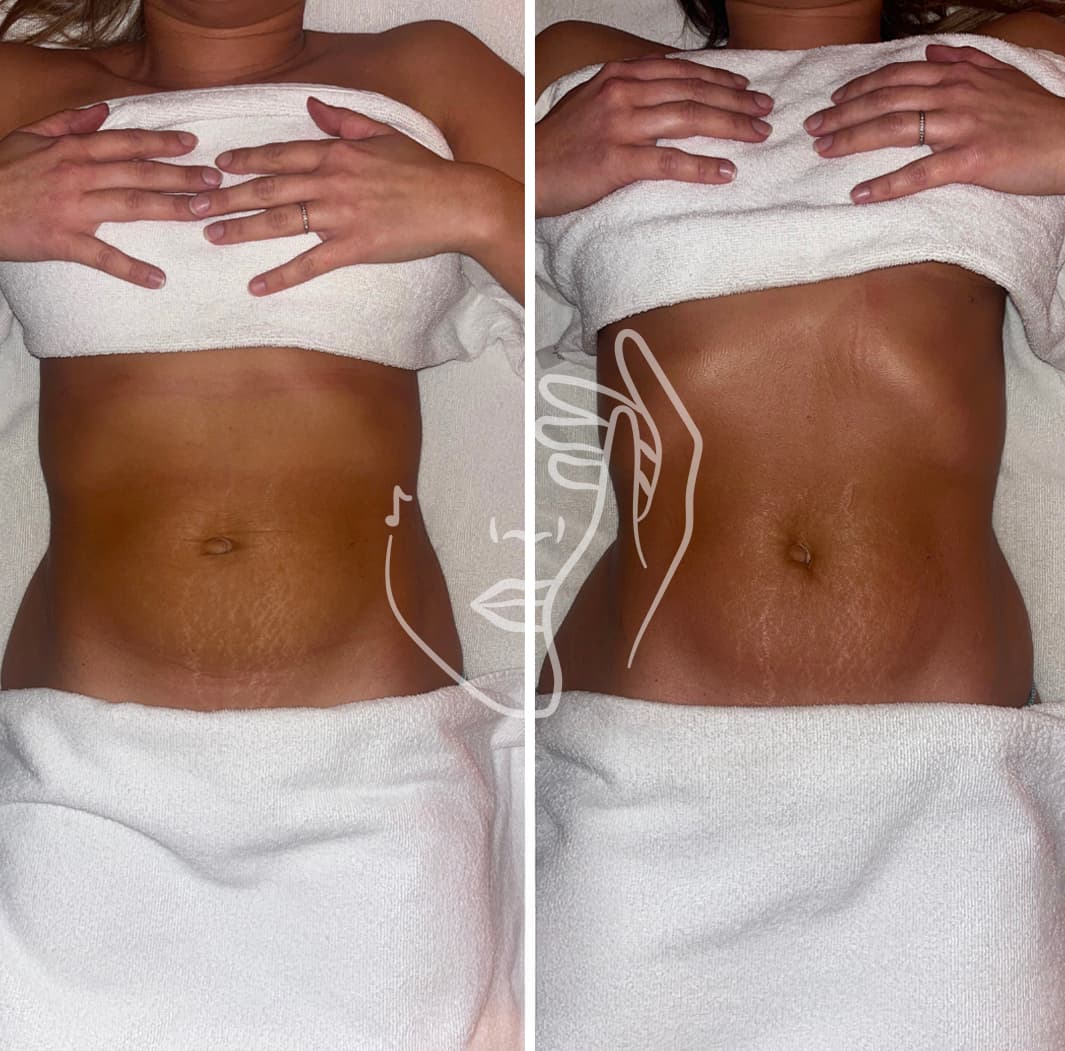 Lympho Sculpt® ANA GIA