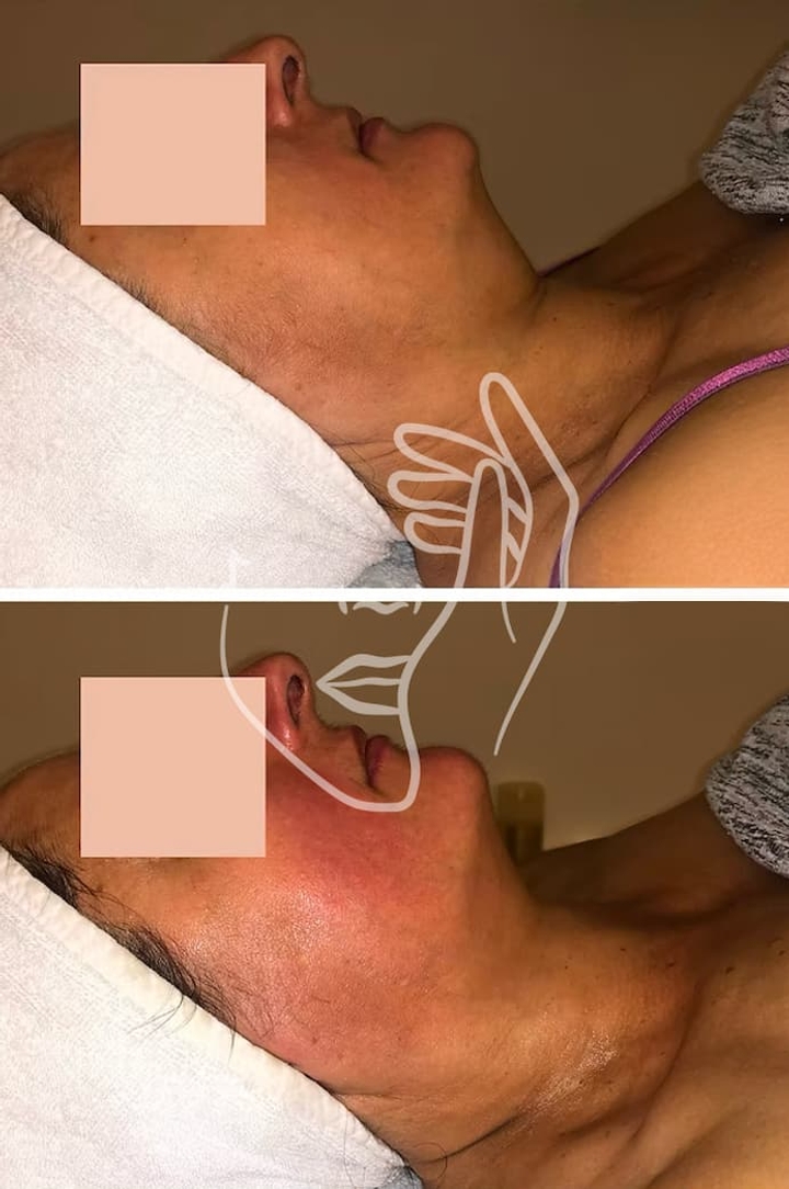 Lympho Sculpt® ANA GIA