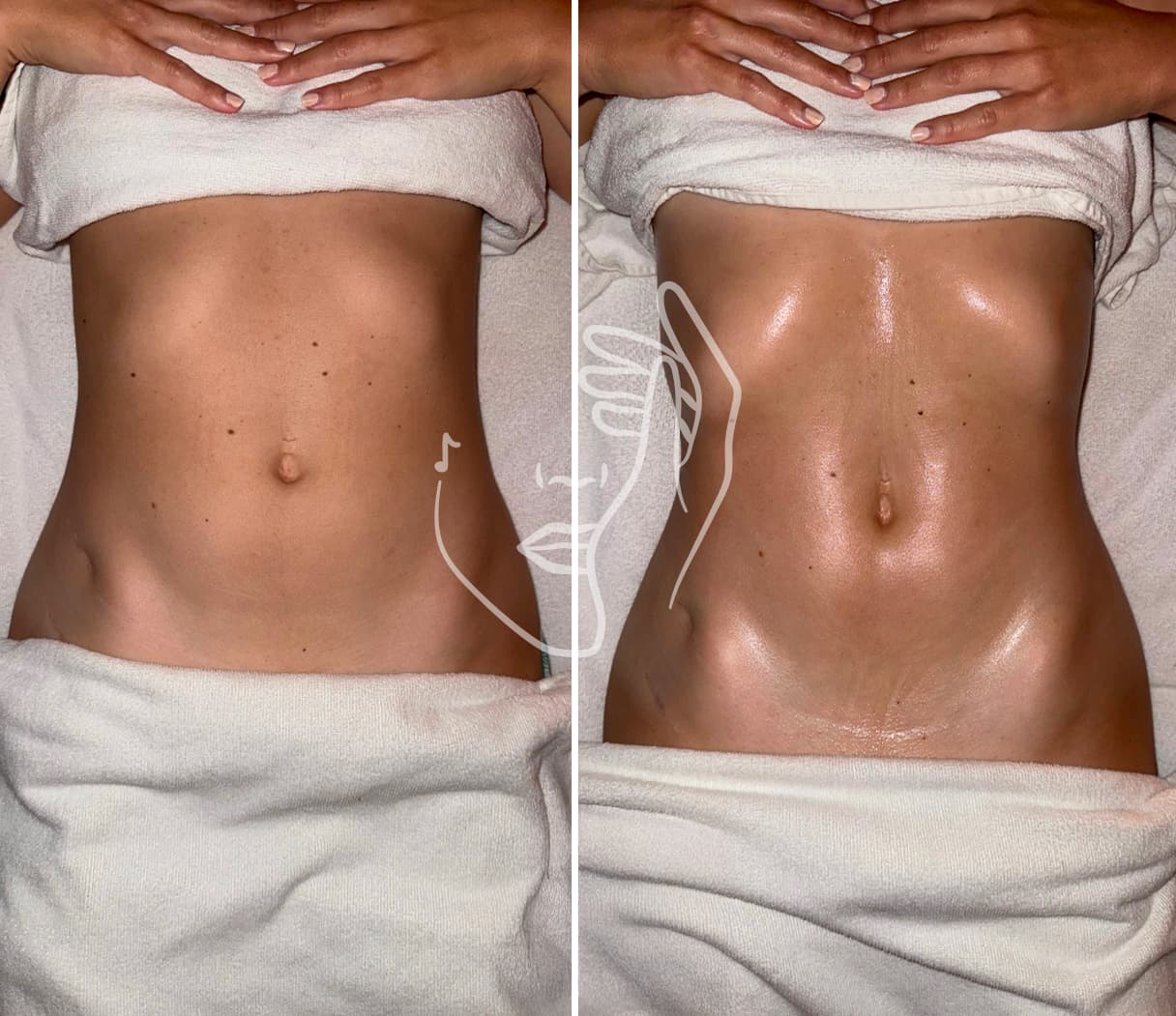 Lympho Sculpt® ANA GIA