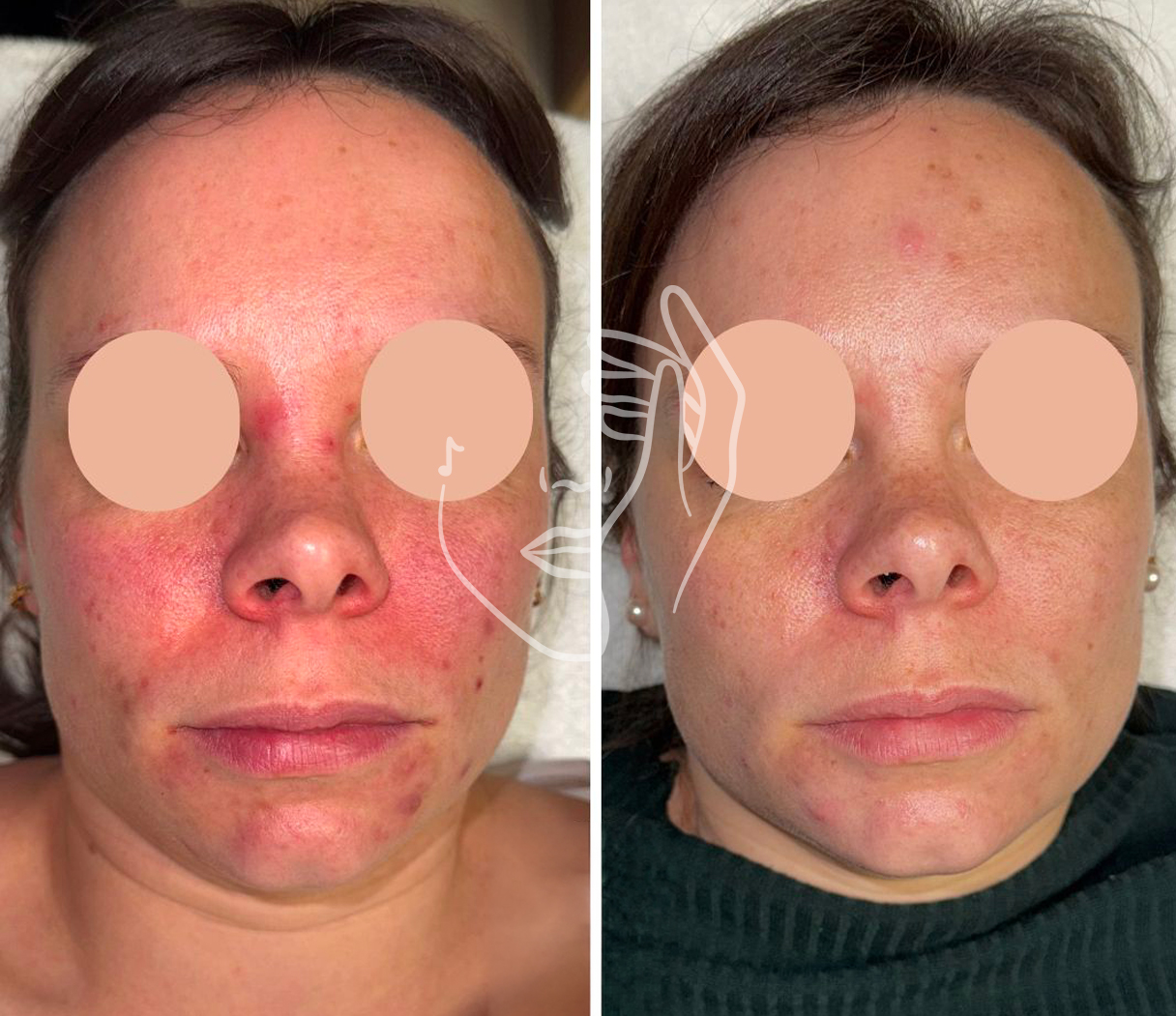 Lympho Sculpt® ANA GIA