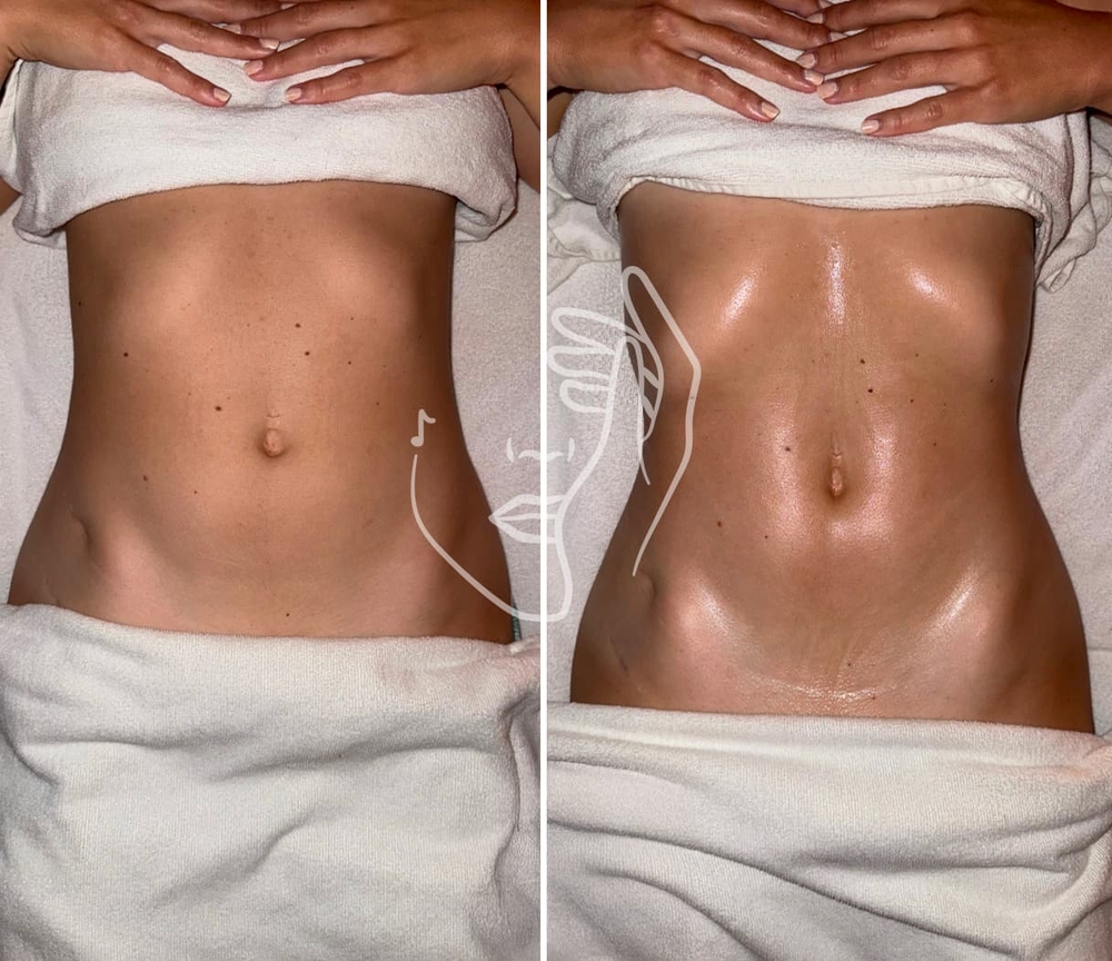Avant-après Lympho Sculpt méthode Ana Gia